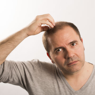 Male Pattern Baldness &#8211; Symptoms And Treatments