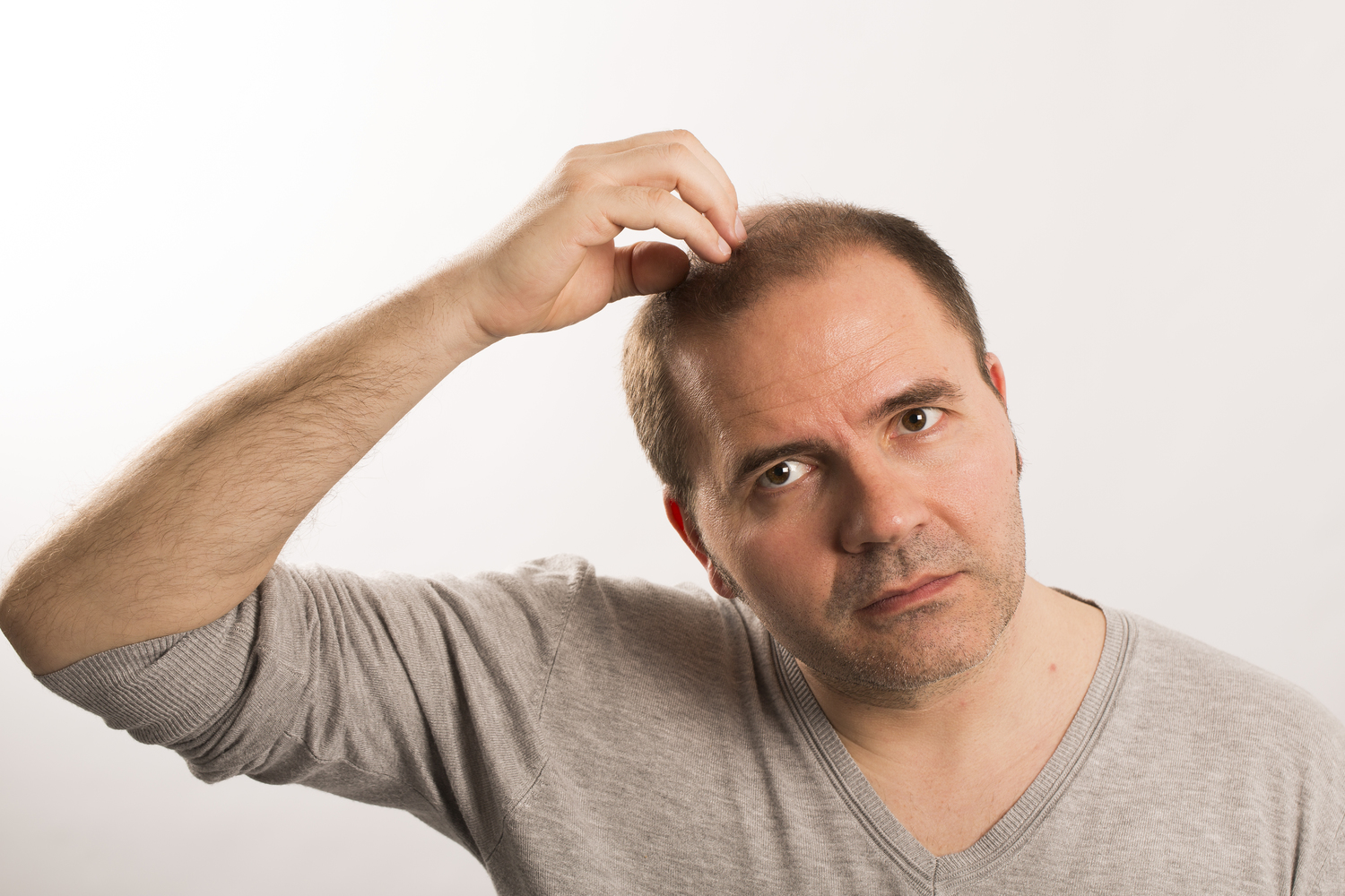 Male Pattern Baldness &#8211; Symptoms And Treatments