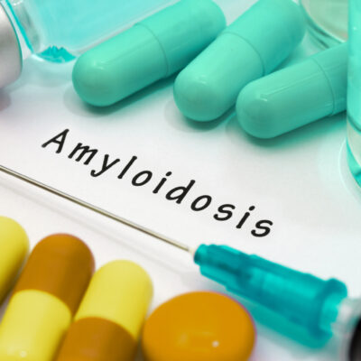 Amyloidosis Symptoms and Treatment