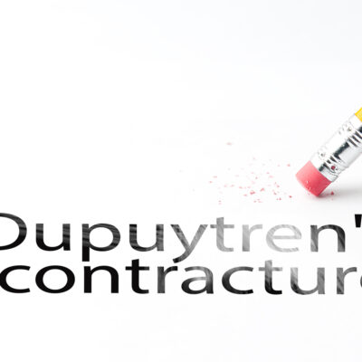 Symptoms of Dupuytren&#8217;s Contracture