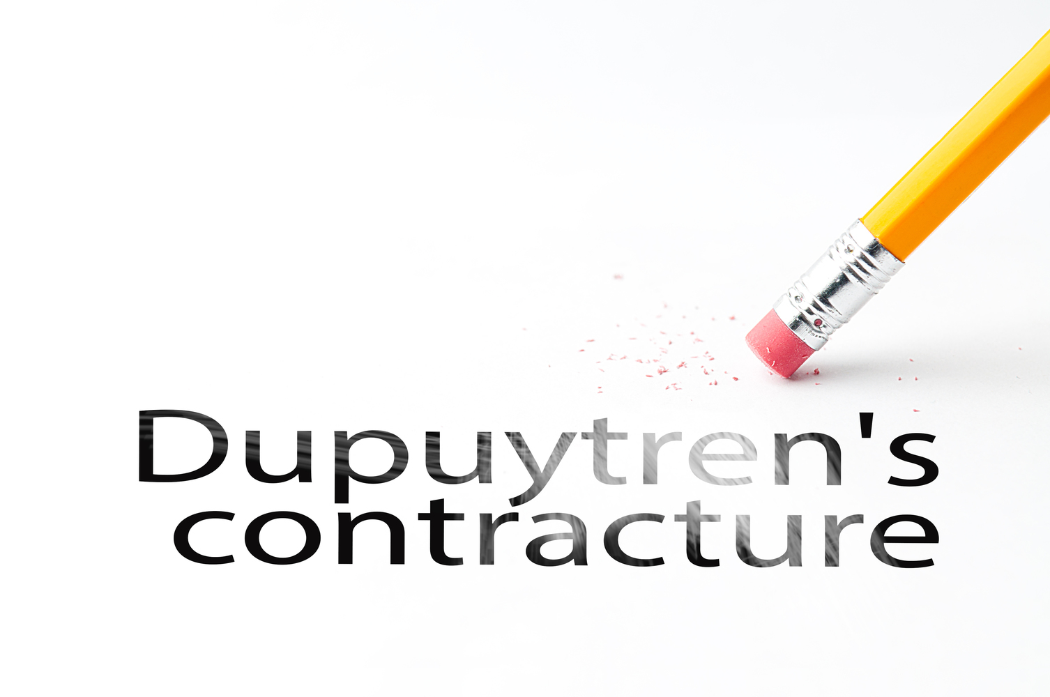 Symptoms of Dupuytren&#8217;s Contracture