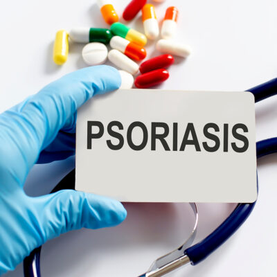 5 Major Causes Of Psoriasis Revealed